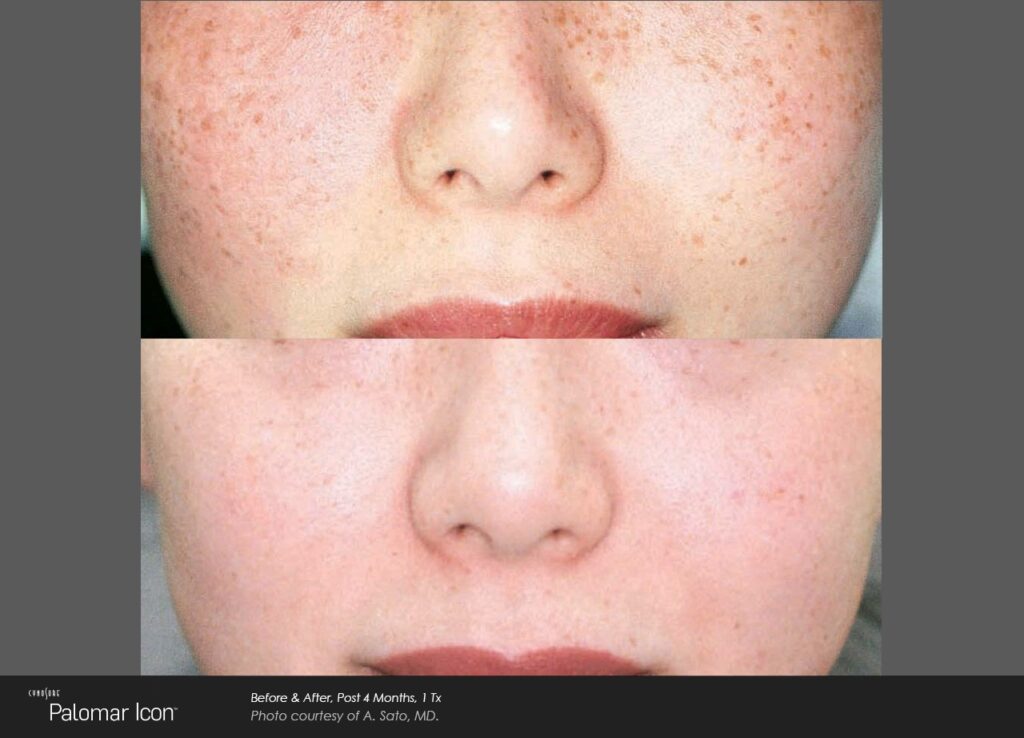skin-revitalization-before-after-photo-2