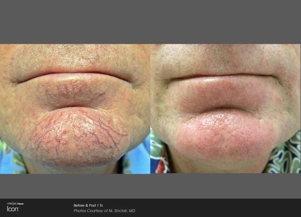 skin-revitalization-before-after-photo-3