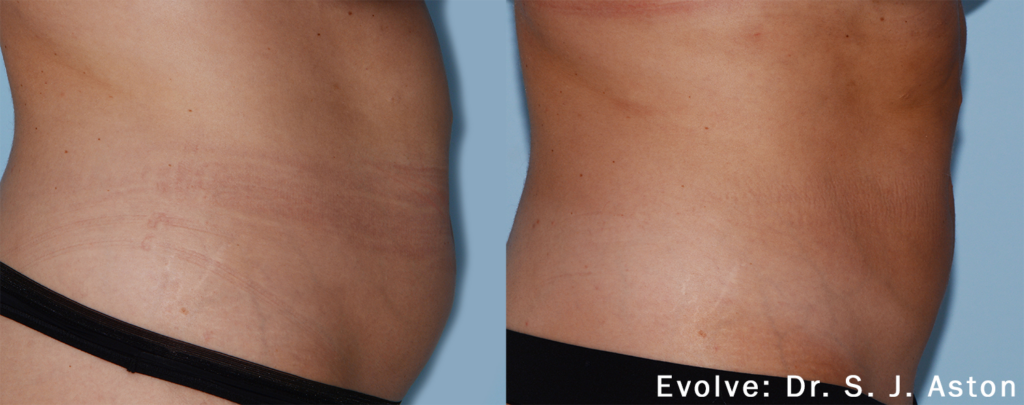 evolve-before-after-dr-r-whitfield-preview-1 (1)