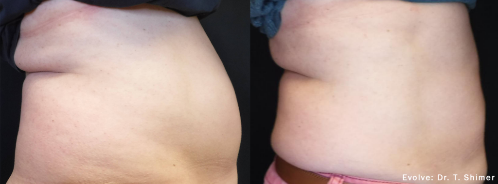 evolve-before-after-dr-t-shimer-preview-3