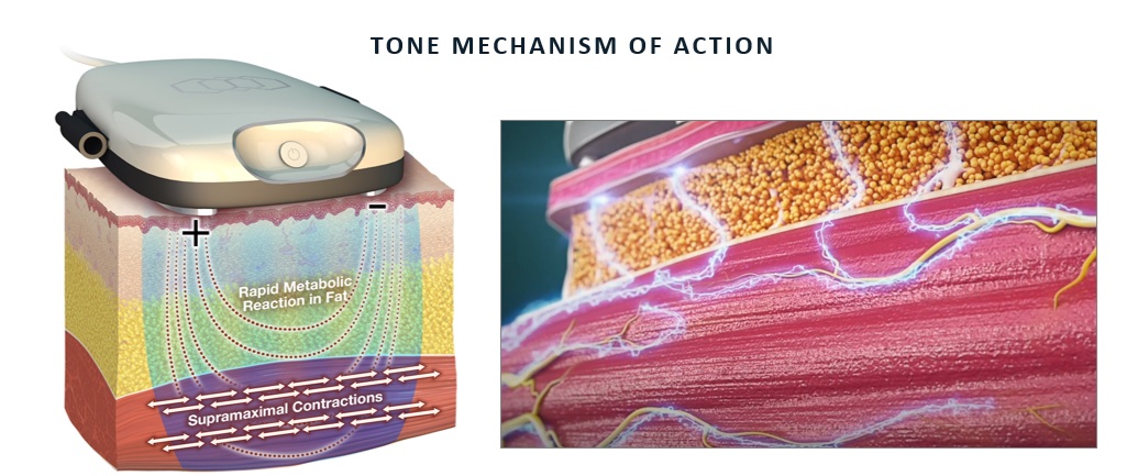 tone-mechanism